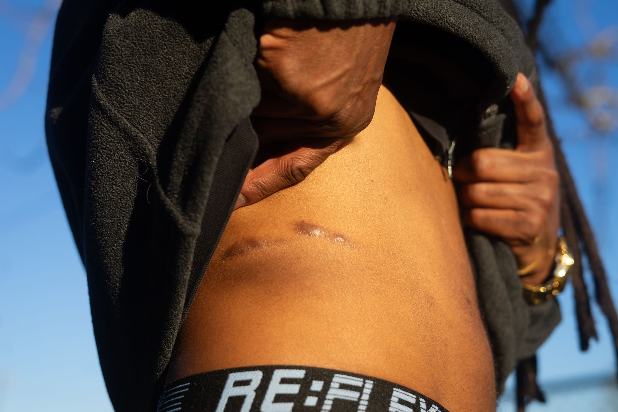 A Black man shows two scars on his stomach.