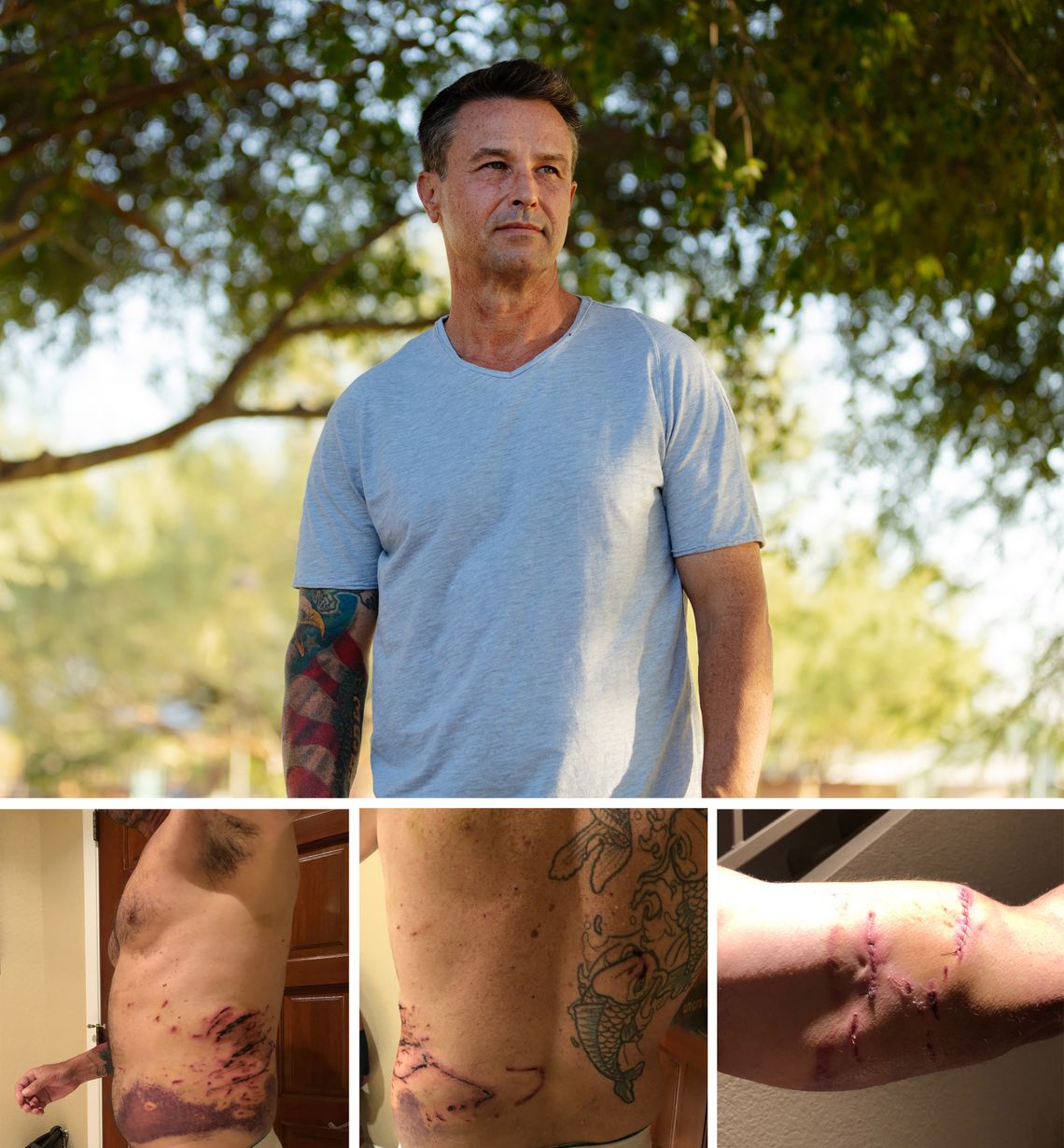 A police dog mauled Patrick Gibbons in Scottsdale, Arizona, in May 2019. The photos below, which Gibbons said were taken about a week after the incident, show his injuries from the dog to his torso and arm. 