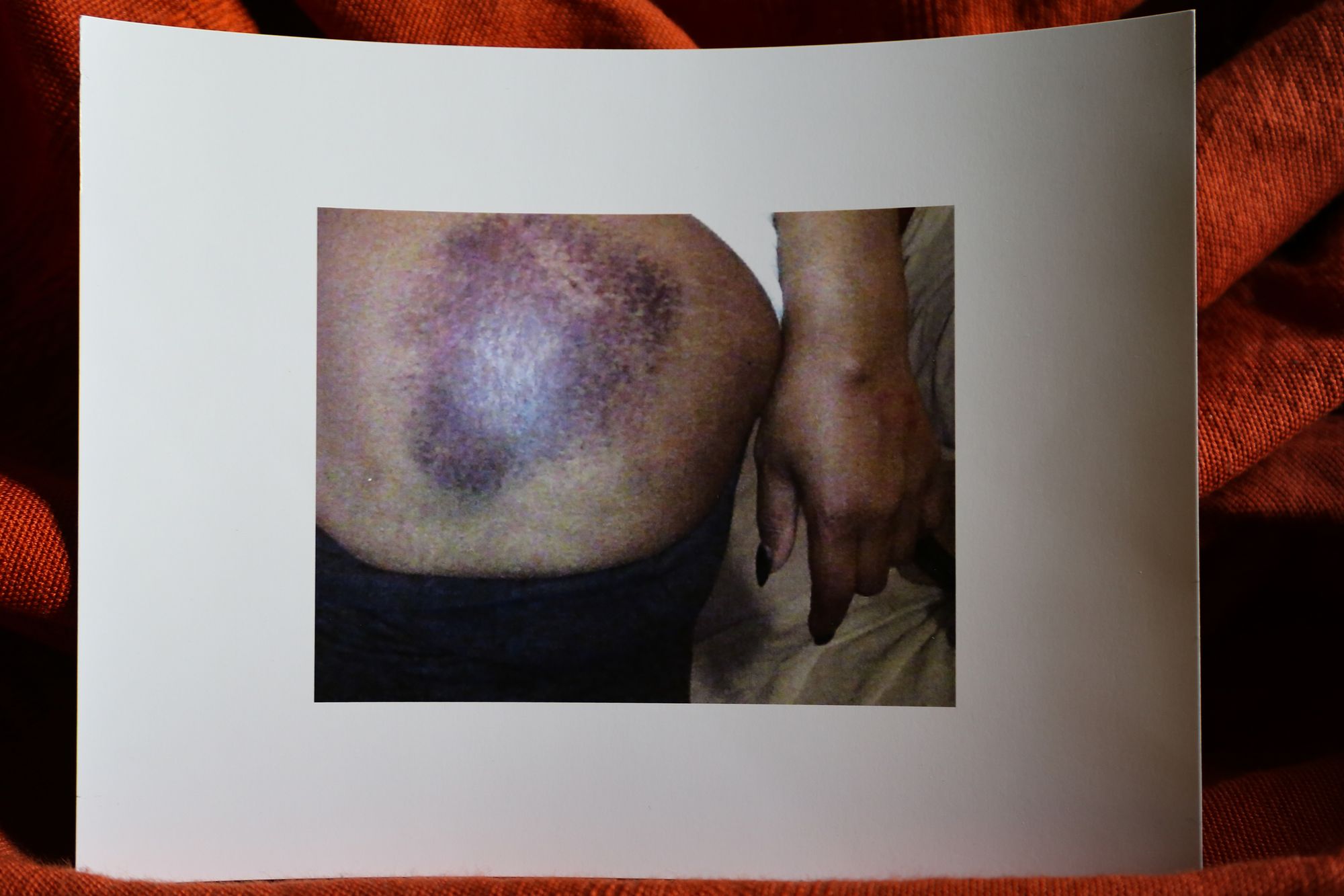 Chicago, IL -- Images of the injuries Patasa Johnson suffered from a CPD sergeant after the officer arrested her in December 2013 for several alleged charges including disarming an officer. Tuesday June 12, 2020. (TMP/Olivia Obineme)