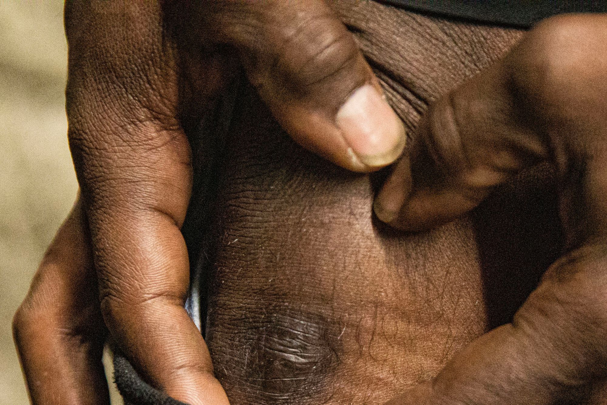 A photo shows a closeup of a scar on the knee of Reginald Dean, a Black man. 