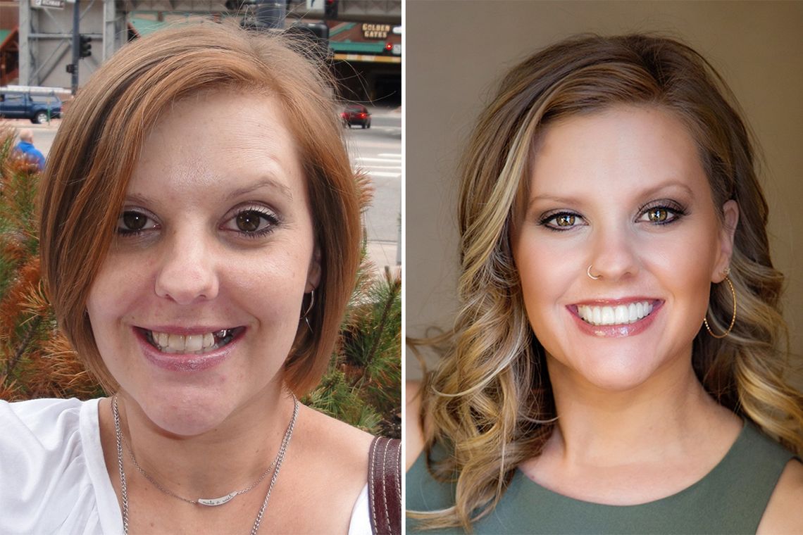 When Kara Burns was released from prison, she was missing multiple teeth and had several other decaying ones. Eventually, a dentist fixed her teeth free of charge. 
