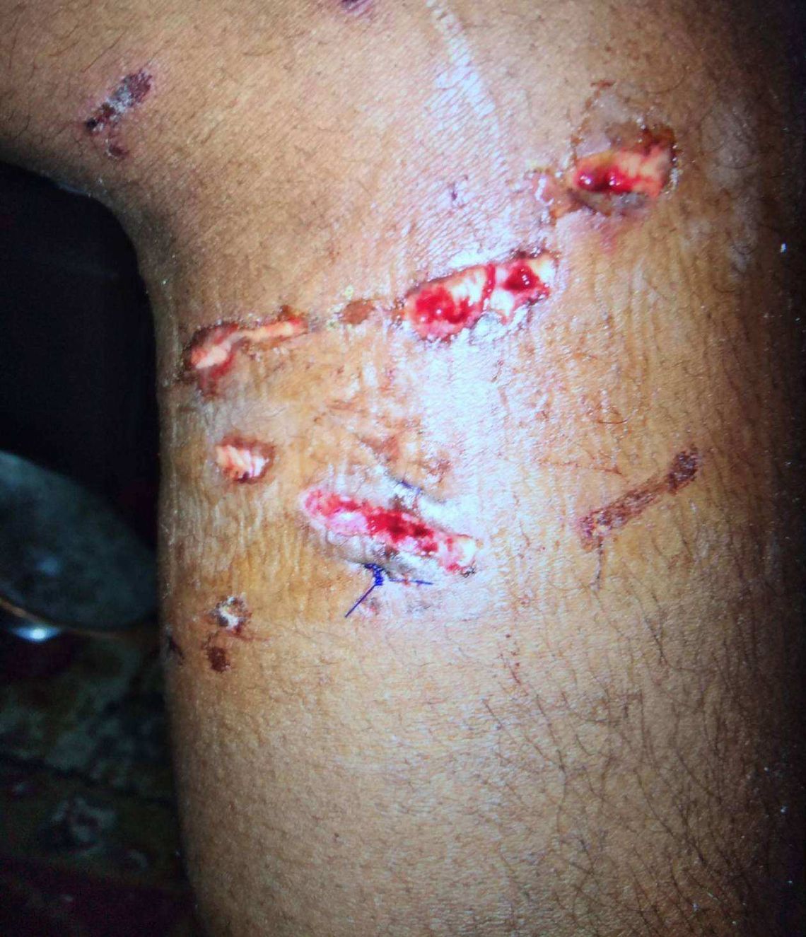 A photo of Charles Carey's injuries to his leg, a day after the police dog bit him. 