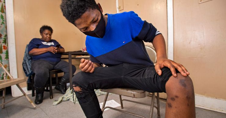 Baton Rouge’s Charles Carey, 19, who was bitten by a Baton Rouge Police Dept. canine in June of 2019 when he was 17 years old, shows the bite marks that can still be seen on his leg, Sunday, Dec. 20, 2020. His grandmother Patricia Rogers is at left, background.