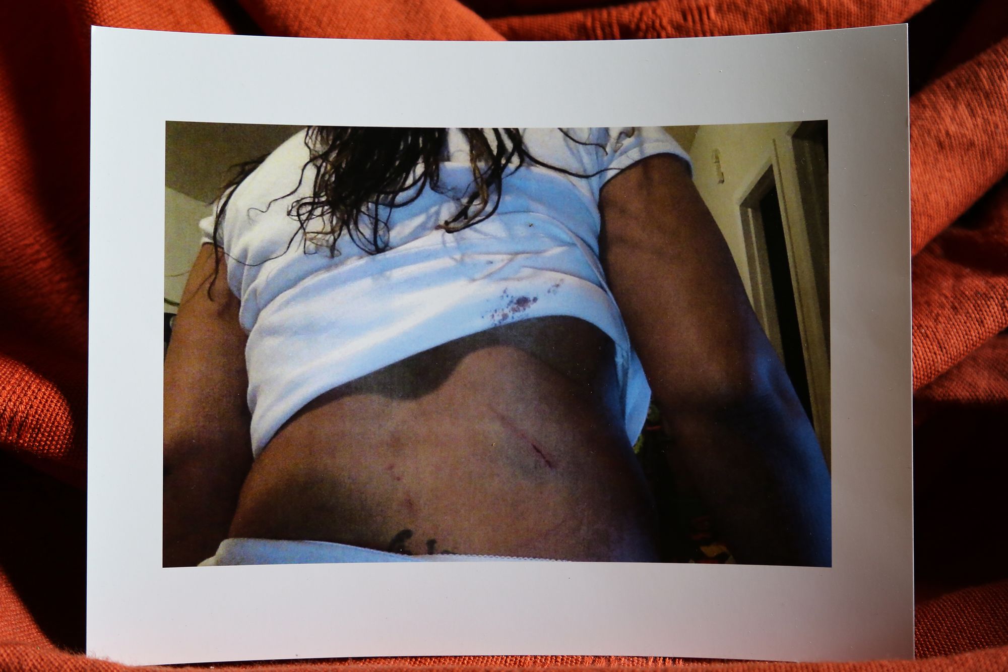 Chicago, IL -- Images of the injuries Patasa Johnson suffered from a CPD sergeant after the officer arrested her in December 2013 for several alleged charges including disarming an officer. Tuesday June 12, 2020. (TMP/Olivia Obineme)