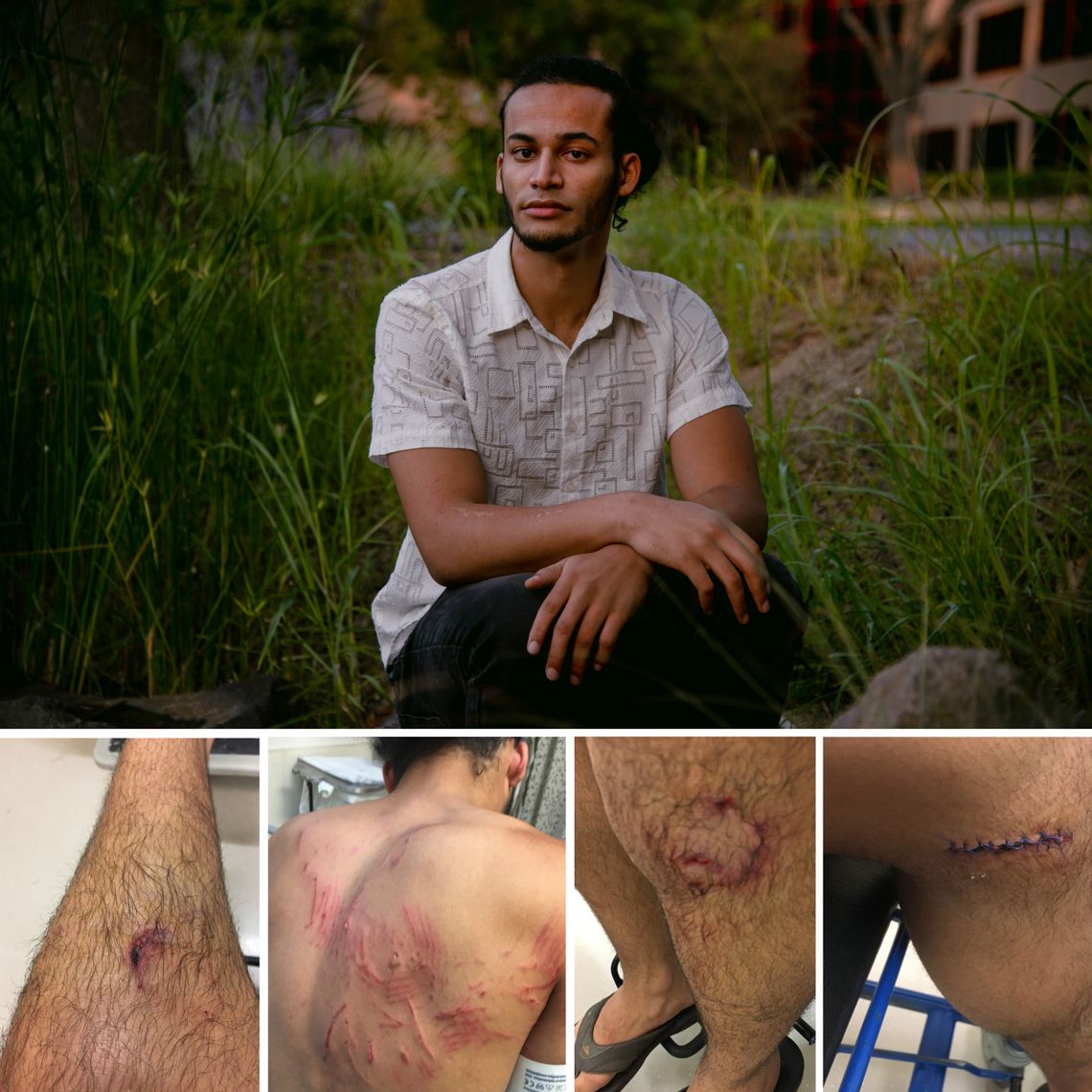 Joseph Malott, a 22-year-old architecture student, was attacked and bitten by a police dog in Walnut Creek, California, during a Black Lives Matter demonstration on June 1. Photos of his back and legs a few hours after the incident. 