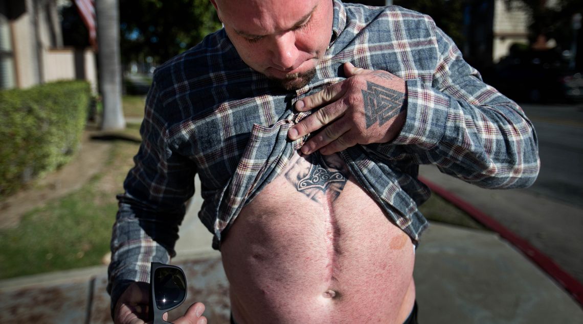 Tanner Mester shows the scar left after he was stabbed in the abdomen by Eric Lund in Huntington Beach, Calif., in 2011. As part of a plea deal, Lund was permitted to pay $100 a night to stay in a smaller city jail instead of the Orange County jail.