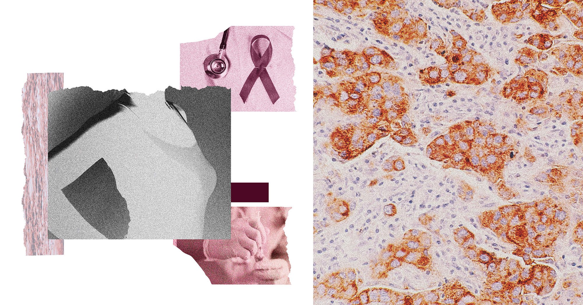 A collage shows images of waves, a woman's chest, a person wearing sterile gloves while holding a syringe, a stethoscope, pink ribbons for breast cancer awareness. A microscopic image of breast cancer cells is shown on the right of the collage. 