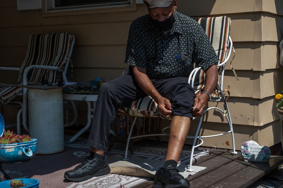 Gordon Mitchum Sr., a retired mail handler of 43 years, pulls up his left pant leg to show the scars left by an Indianapolis Metropolitan Police Department dog bite.