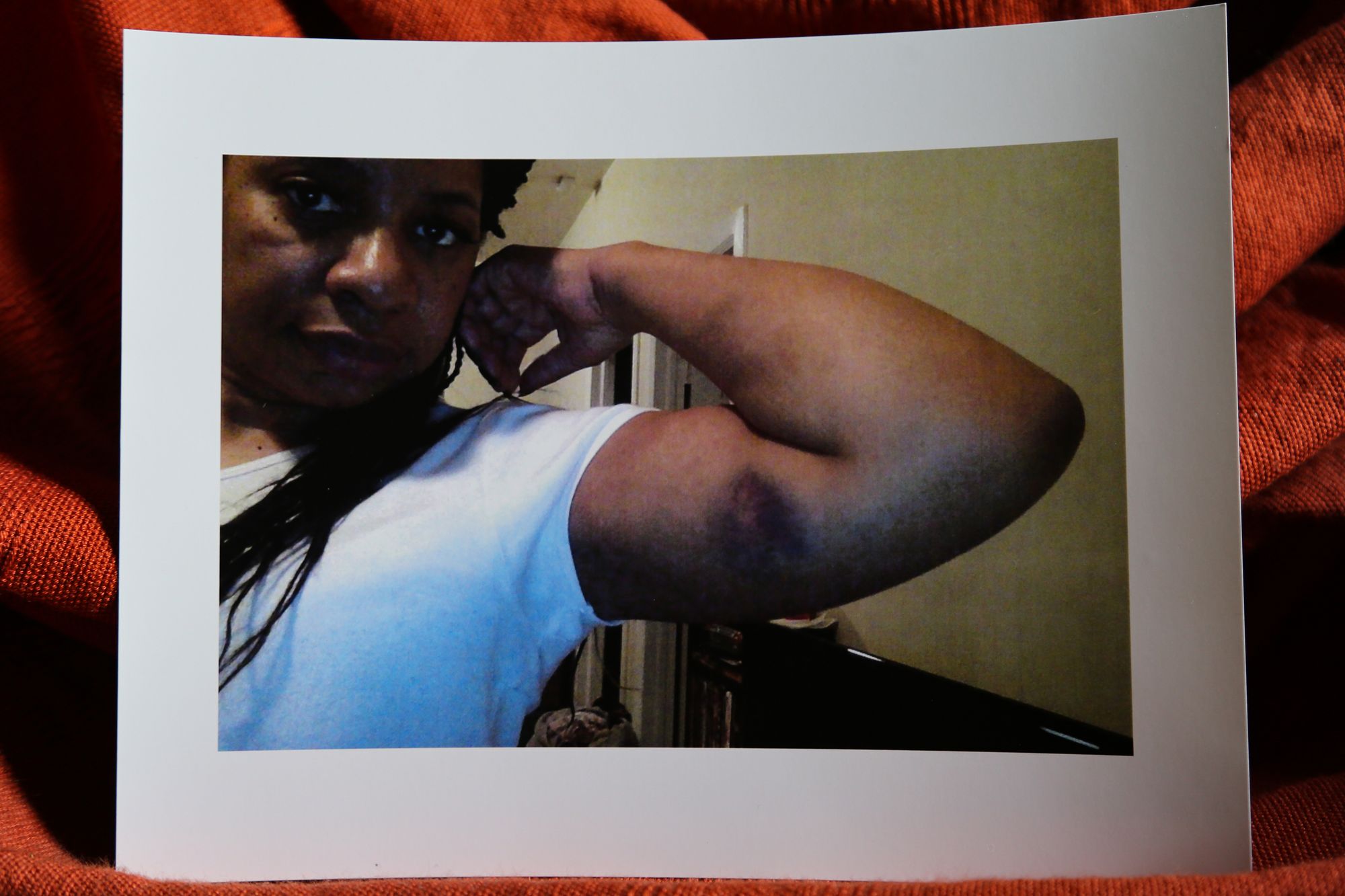 Chicago, IL -- Images of the injuries Patasa Johnson suffered from a CPD sergeant after the officer arrested her in December 2013 for several alleged charges including disarming an officer. Tuesday June 12, 2020. (TMP/Olivia Obineme)